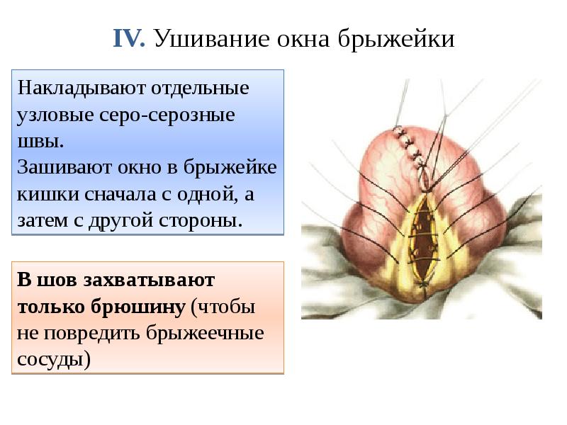 IV. Ушивание окна брыжейки