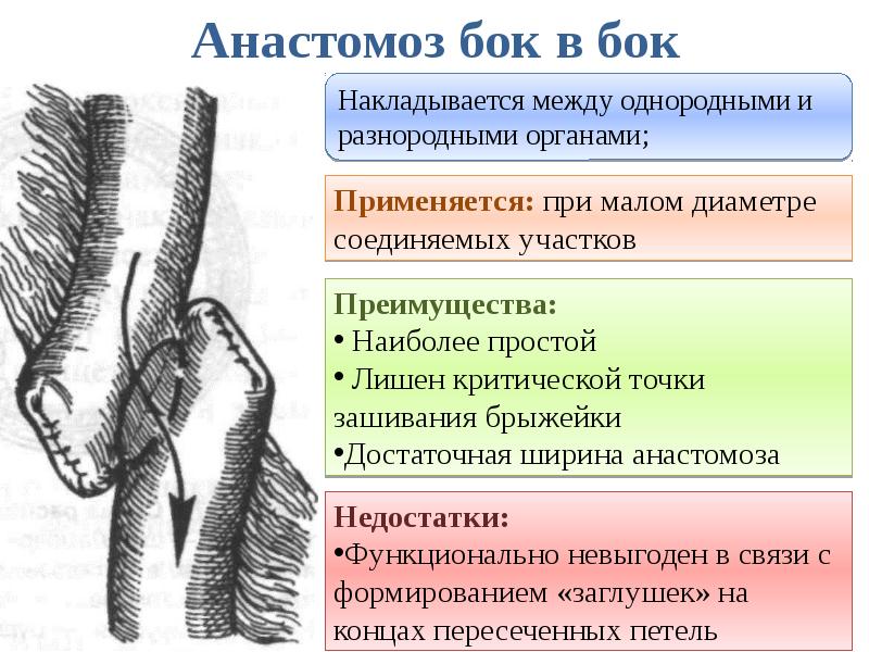 Анастомоз бок в бок
