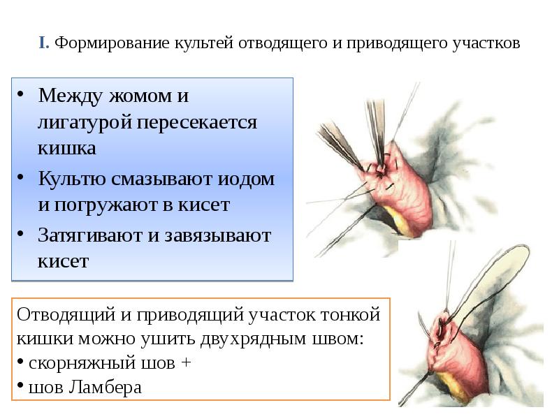 I. Формирование культей отводящего и приводящего участков  Между жомом и