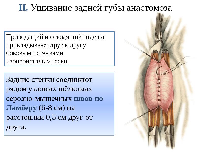 II. Ушивание задней губы анастомоза   Задние стенки соединяют рядом