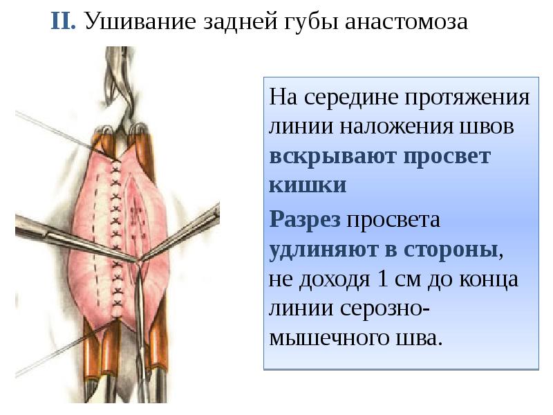 II. Ушивание задней губы анастомоза   На середине протяжения линии