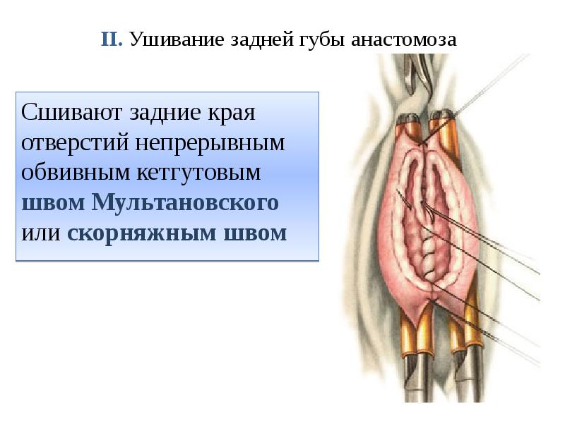 II. Ушивание задней губы анастомоза   Сшивают задние края отверстий