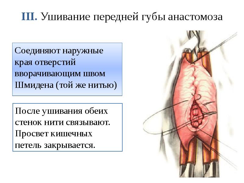 III. Ушивание передней губы анастомоза  Соединяют наружные края отверстий вворачивающим