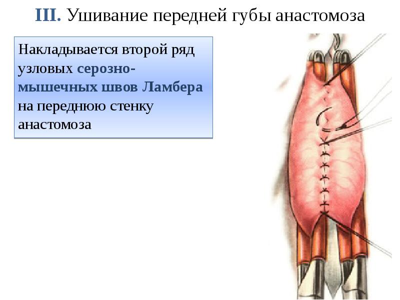 III. Ушивание передней губы анастомоза  Накладывается второй ряд узловых серозно-мышечных