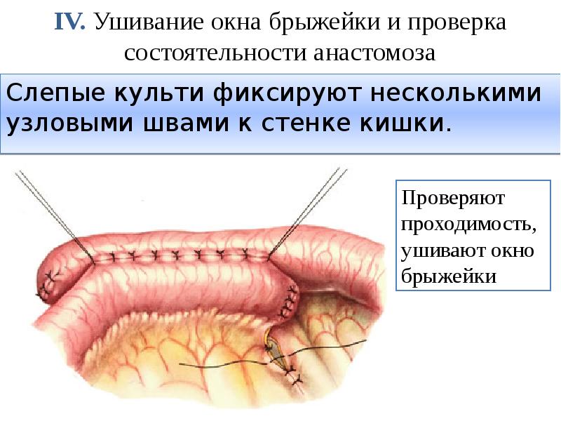 IV. Ушивание окна брыжейки и проверка состоятельности анастомоза Слепые культи фиксируют