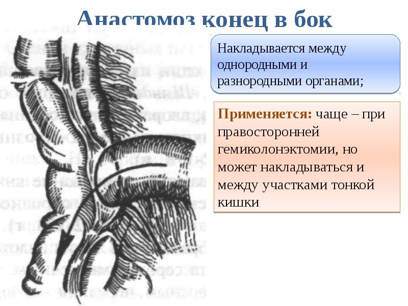 Анастомоз конец в бок