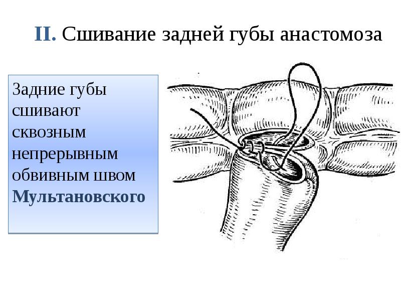 Задние губы сшивают сквозным непрерывным обвивным швом Мультановского Задние губы сшивают