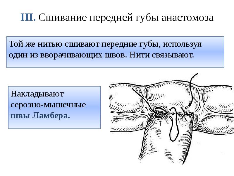 III. Сшивание передней губы анастомоза