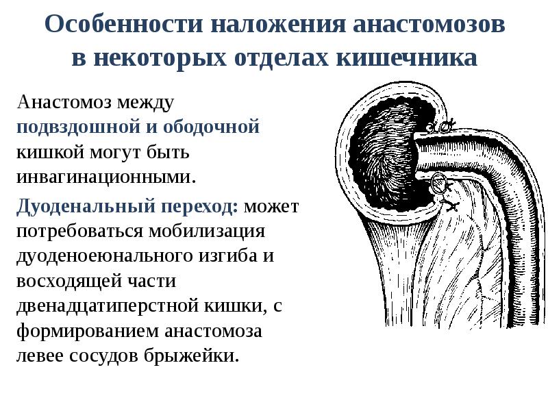Особенности наложения анастомозов в некоторых отделах кишечника Анастомоз между подвздошной и