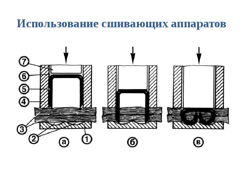 Использование сшивающих аппаратов