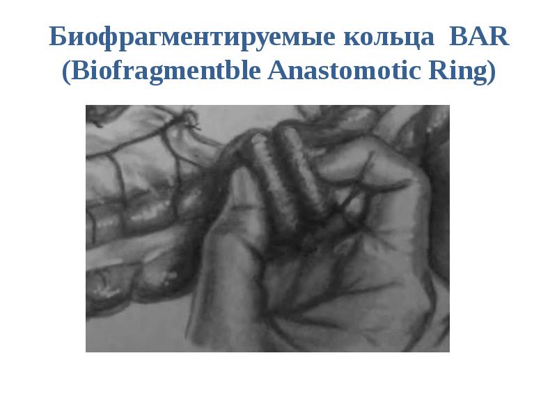 Биофрагментируемые кольца BAR (Biofragmentble Anastomotic Ring)