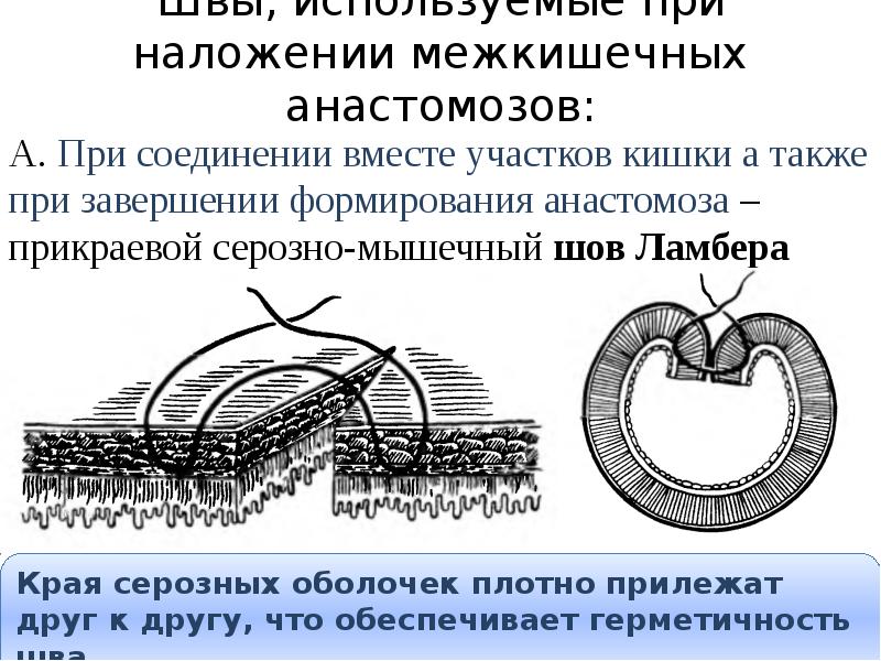 Швы, используемые при наложении межкишечных анастомозов:  А. При соединении вместе