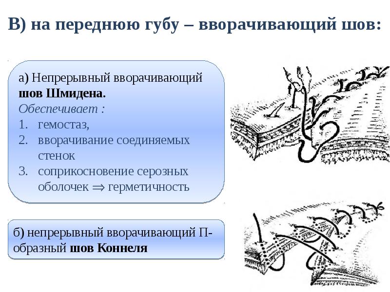 В) на переднюю губу – вворачивающий шов: