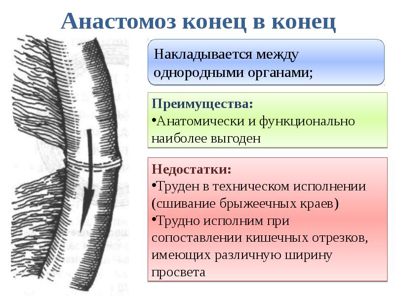 Анастомоз конец в конец