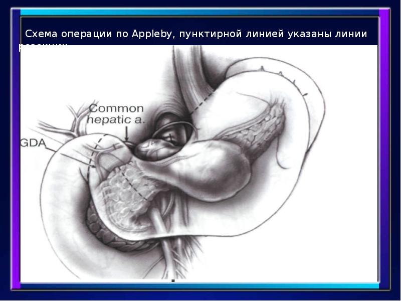Операция бегера на поджелудочной железе схема