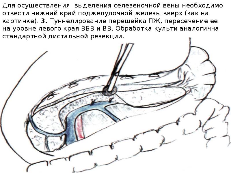 Операция фрея на поджелудочной железе схема