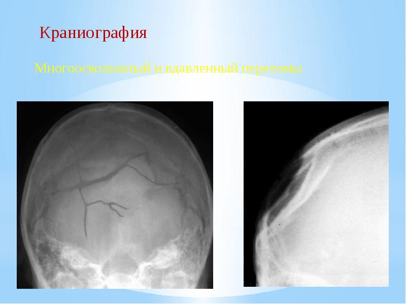 Черепно мозговая травма презентации