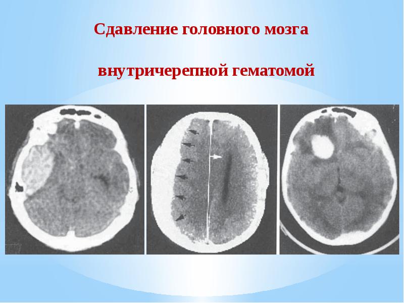 Презентация ушиб головного мозга