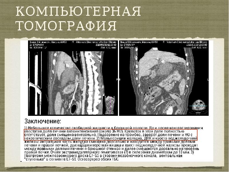 Компьютерная томография