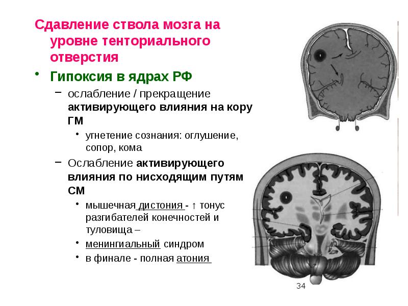 Сдавление головного мозга презентация