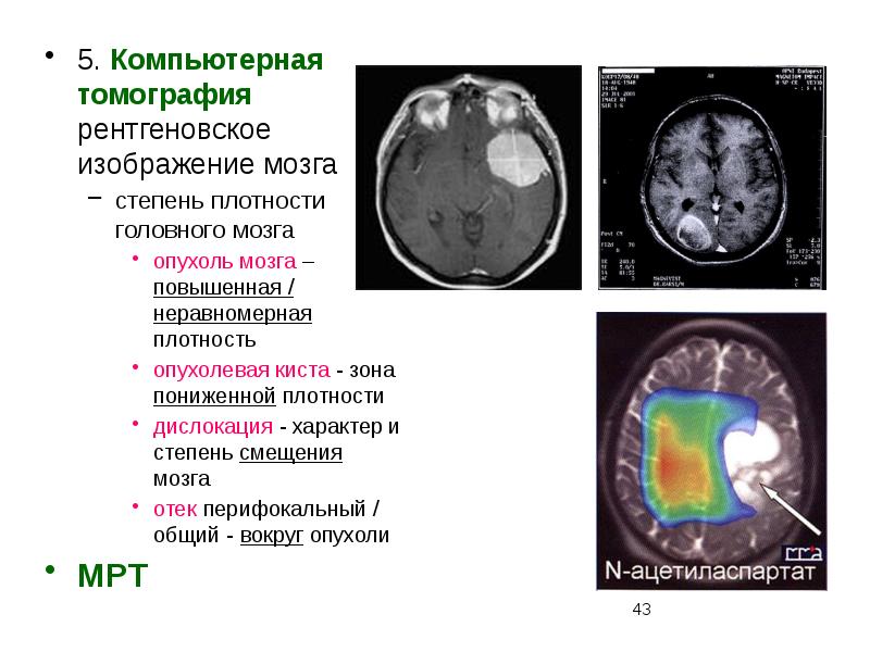 Опухоль мозга презентация