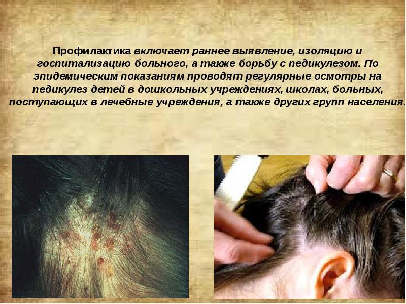 Профилактика включает раннее выявление, изоляцию и госпитализацию больного, а также борьбу