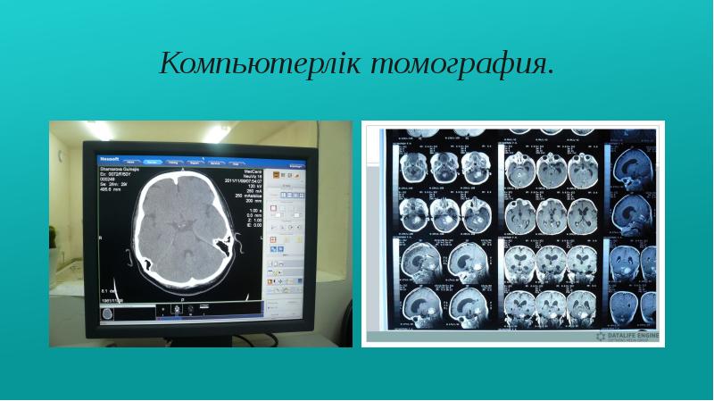 Компьютерная томография презентация