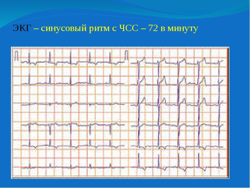 Что значить синусовый ритм. Синусовый ритм с ЧСС 61. Кардиограмма расшифровка синусовый ритм. ЭКГ синусовый ритм ЭОС нормальная. Ритм синусовый чсс72 левограмма.