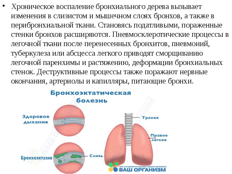 Слюнокаменная болезнь презентация