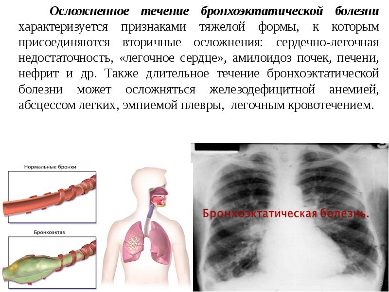 Бронхоэктатическая болезнь презентация