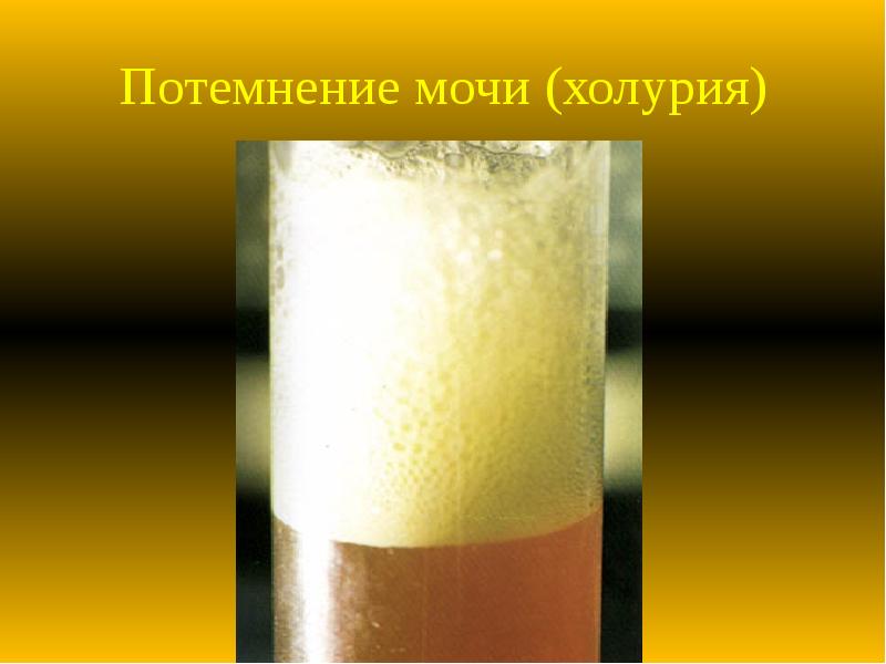 Потемнение мочи (холурия) Потемнение мочи (холурия)