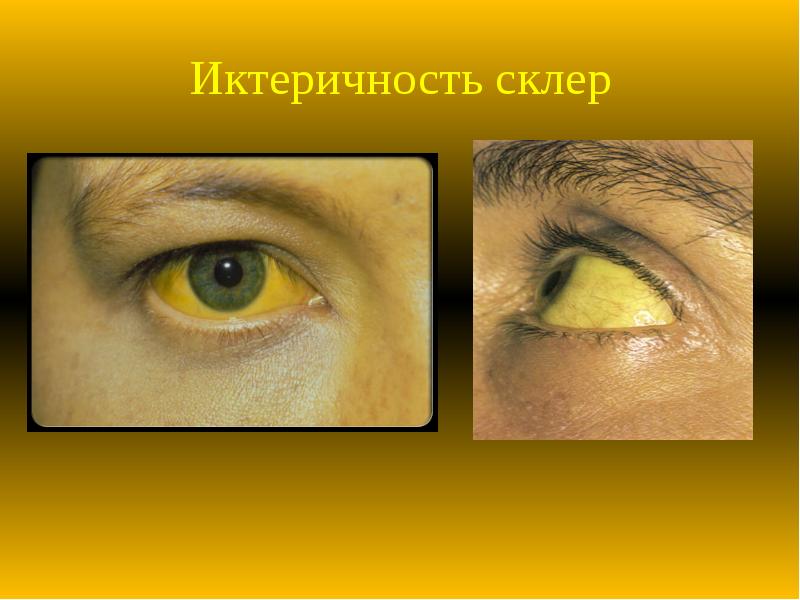 Иктеричность склер Иктеричность склер