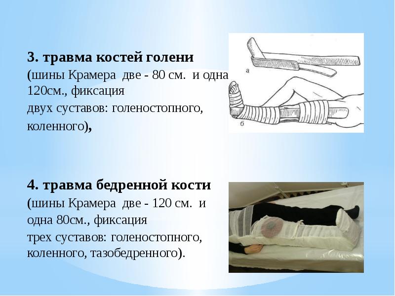 Сколько суставов необходимо зафиксировать при иммобилизации. Транспортная иммобилизация при переломе бедренной кости. Иммобилизация при переломе костей голени. Шины транспортные для иммобилизации нижних конечностей. Протяженность иммобилизации при переломе бедра.