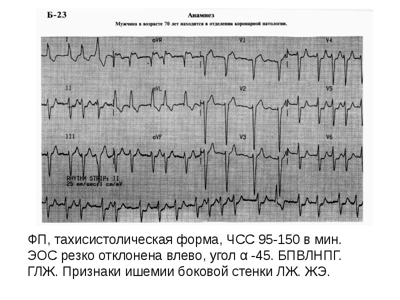 Анамнез при стенокардии. Мерцательная аритмия тахисистолическая форма ЭКГ. Пароксизмальная фибрилляция предсердий на ЭКГ.