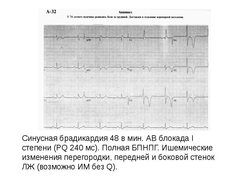 Окс нестабильная стенокардия карта вызова