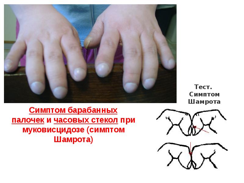 Симптом теста. Барабанные палочки при муковисцидозе. Симптом барабанных палочек и часовых стекол. Симптом барабанных палочек.