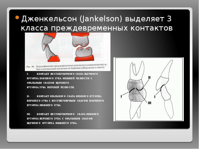 Дженкельсон (Jankelson) выделяет 3 класса преждевременных контактов
Дженкельсон (Jankelson) выделяет 3 Дженкельсон (Jankelson) выделяет 3 класса преждевременных контактов
Дженкельсон (Jankelson) выделяет 3