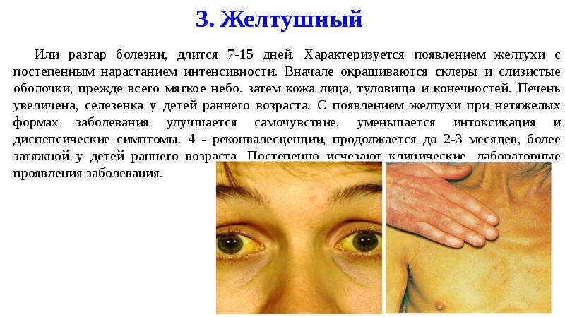 Вирусный гепатит желтушный период. Желтуха при вирусном гепатите. Желтушность кожных покровов и слизистых. Желтушный период гепатита а. Желтушность кожи и склер.