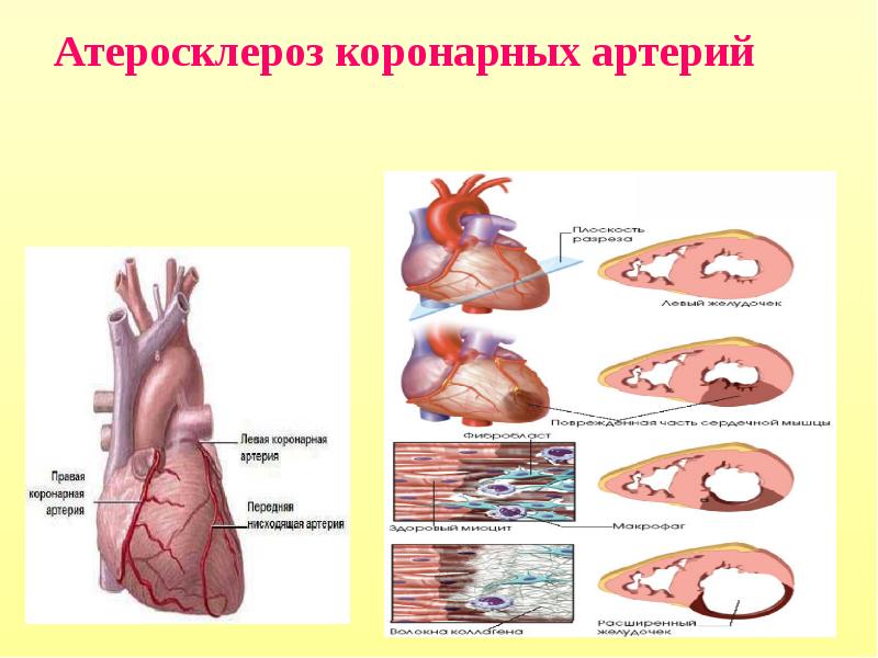 Коронарный атеросклероз в картинках