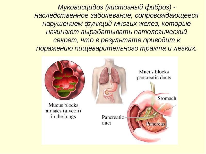 Муковисцидоз это