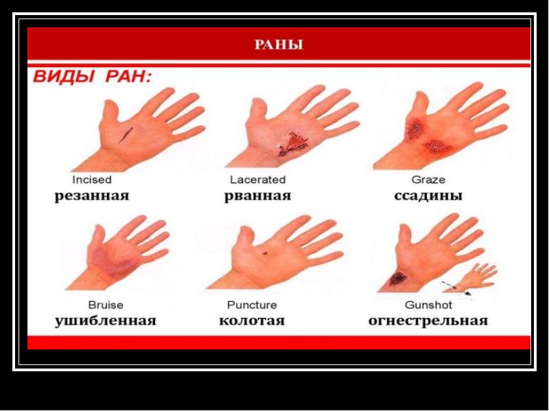 Виды ран и их характеристика презентация