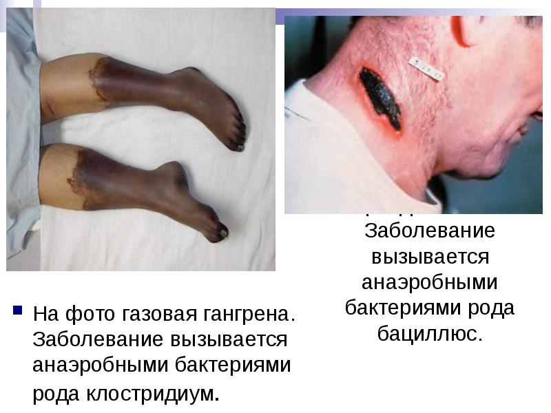 На фото газовая гангрена. Заболевание вызывается анаэробными бактериями рода клостридиум.