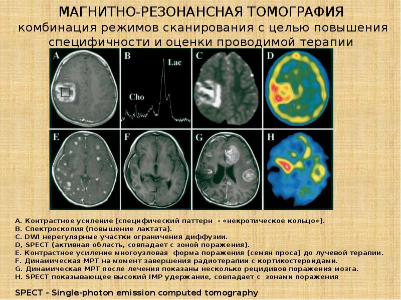 Опухоли головного и спинного мозга презентация