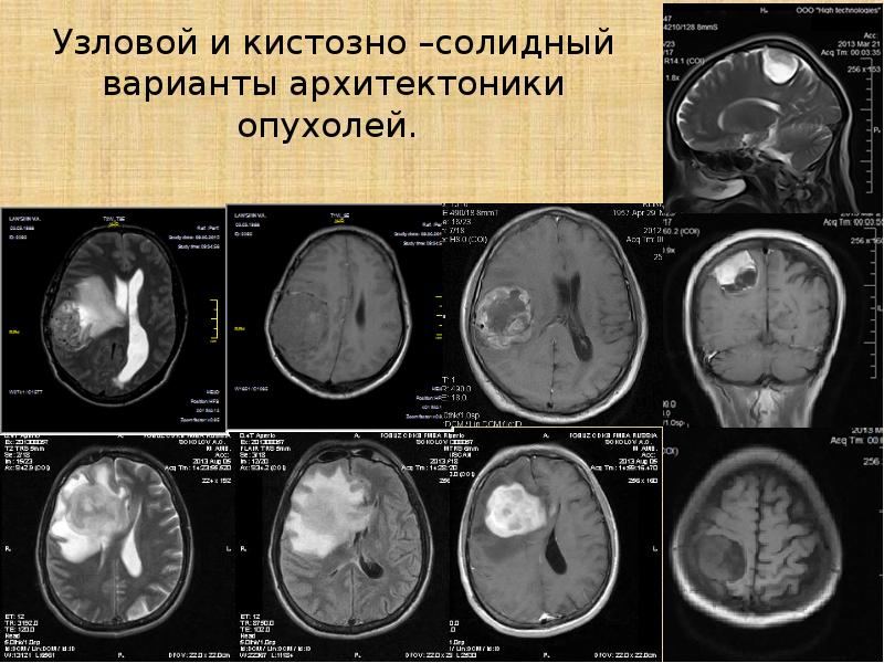 Опухоли мозга неврология