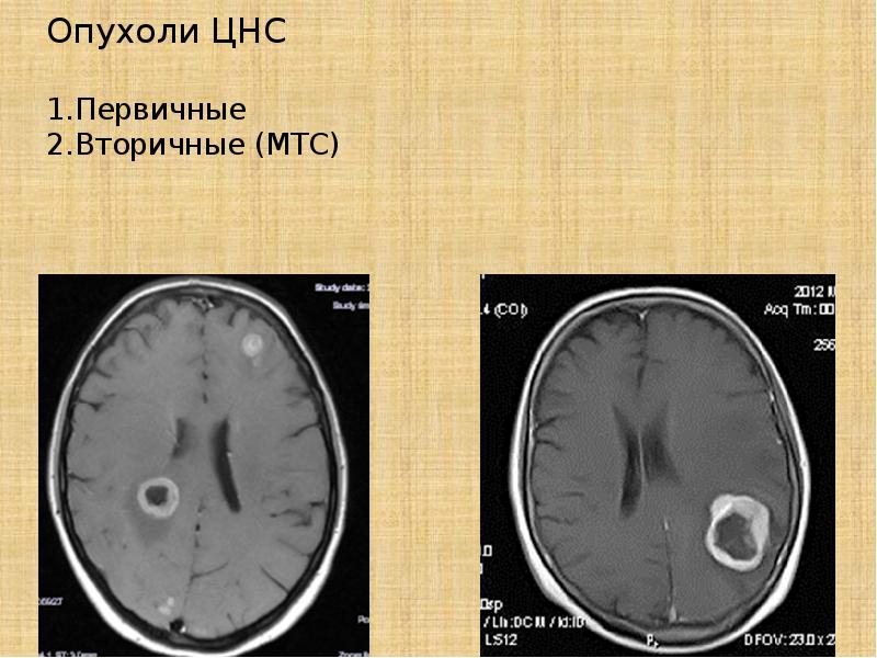 Опухоли головного и спинного мозга презентация