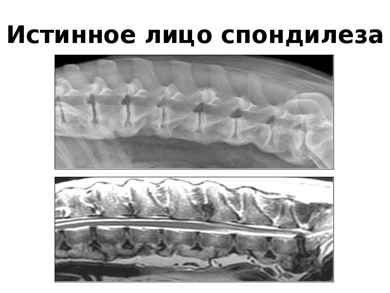 Деформирующий спондилез рентген. Как лечить спондилез. Спондилез с3-с7 позвонков. Спондилез передней продольной связки. Спондилез шейного отдела позвонка.