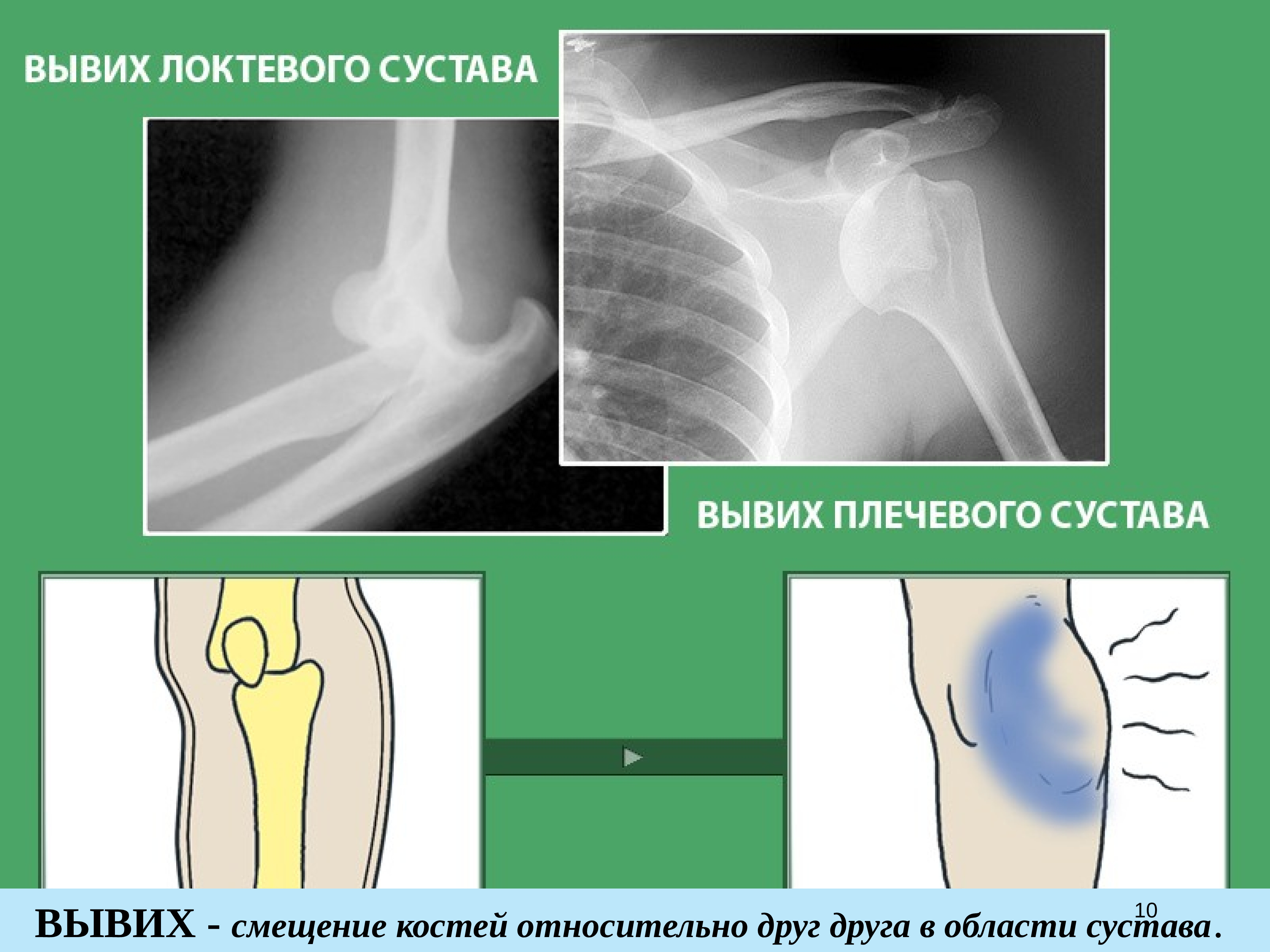 Вывих колена. Смещение костей относительно друг друга в области сустава это. Смещение костей в суставе.