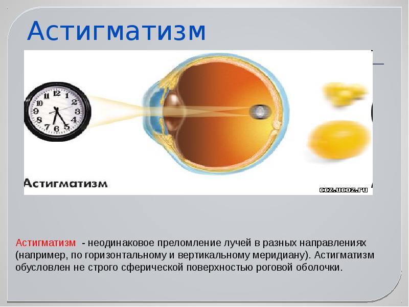 Презентация на тему астигматизм