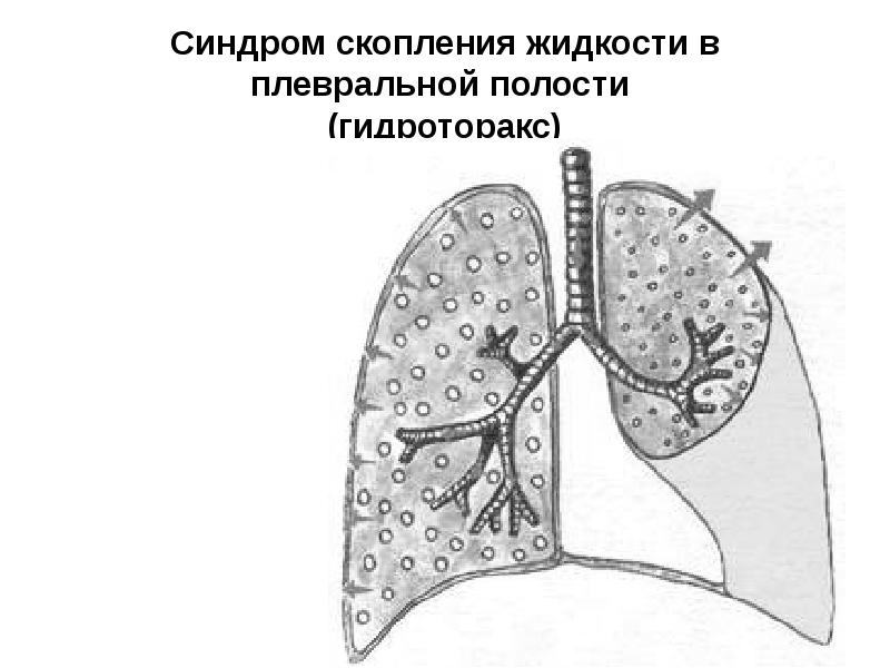 Для клинической картины плеврита характерно