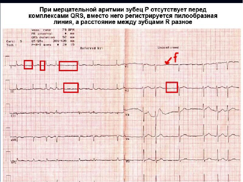 Нормальная кардиограмма сердца фото у взрослого фото